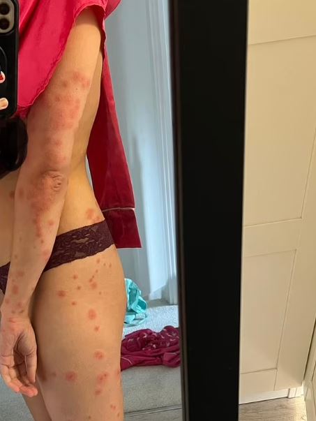 Holidaymaker covered in a HUNDRED bedbug bites after trip - the worst case doctor had EVER seen 5