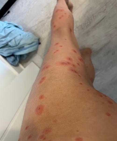Holidaymaker covered in a HUNDRED bedbug bites after trip - the worst case doctor had EVER seen 6
