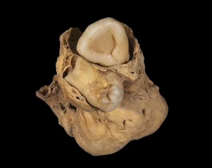Tumor with TEETH is unearthed in the remains of ancient Egyptian woman 1