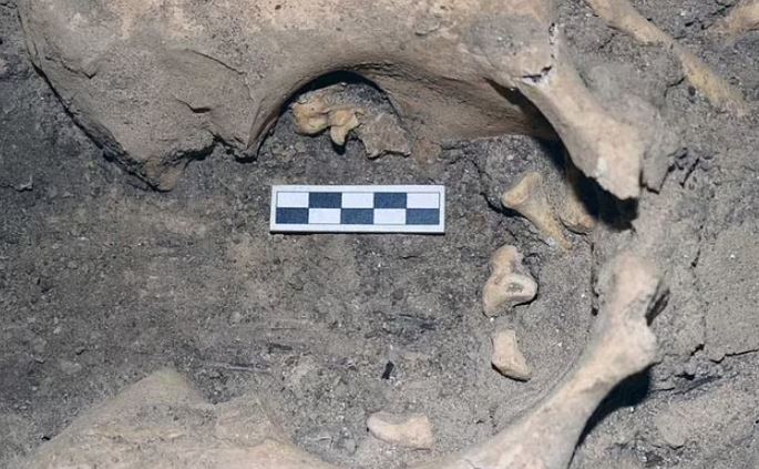 Tumor with TEETH is unearthed in the remains of ancient Egyptian woman 3