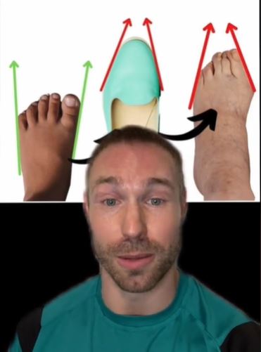 Expert reveals a clever trick that can banish nasty bunions 5