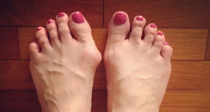 Expert reveals a clever trick that can banish nasty bunions 6