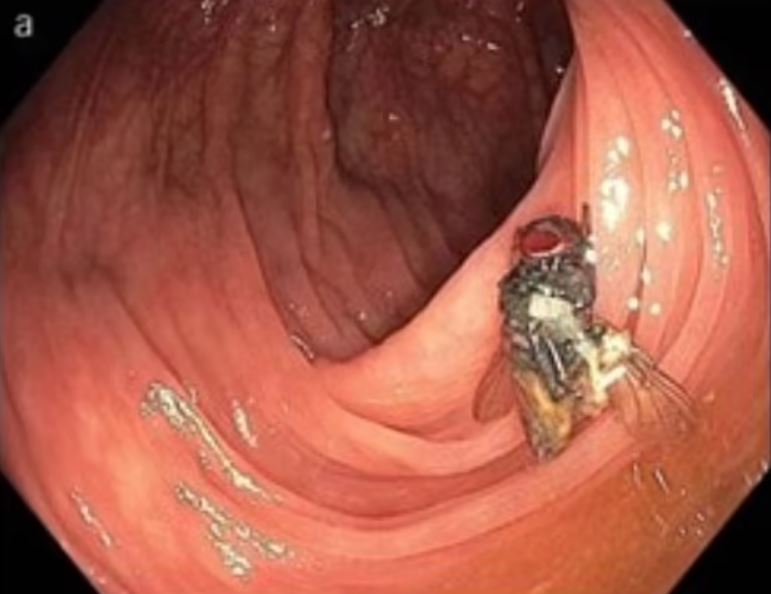 Doctors stunned after discovering fly buzzing in man's intestines 2