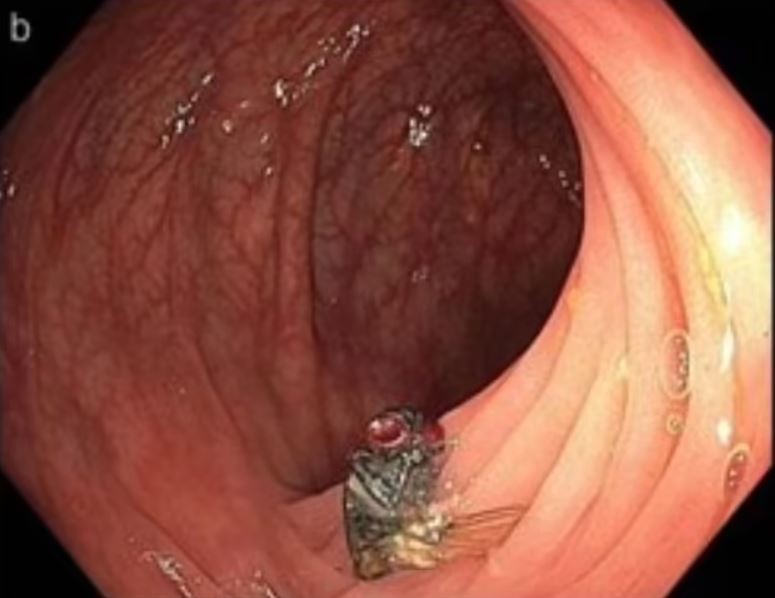 Doctors stunned after discovering fly buzzing in man's intestines 3