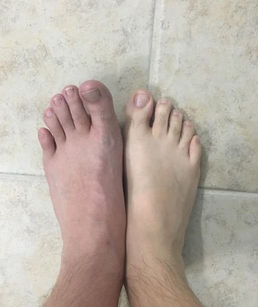 Texas man stunned after spotting an infection on foot from showering barefoot at the gym 1