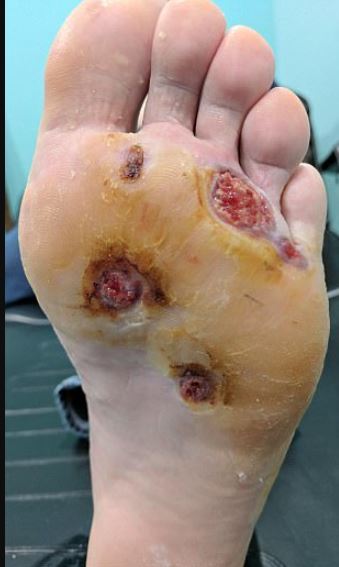 Texas man stunned after spotting an infection on foot from showering barefoot at the gym 2