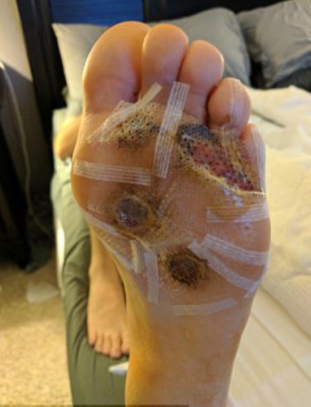 Texas man stunned after spotting an infection on foot from showering barefoot at the gym 3