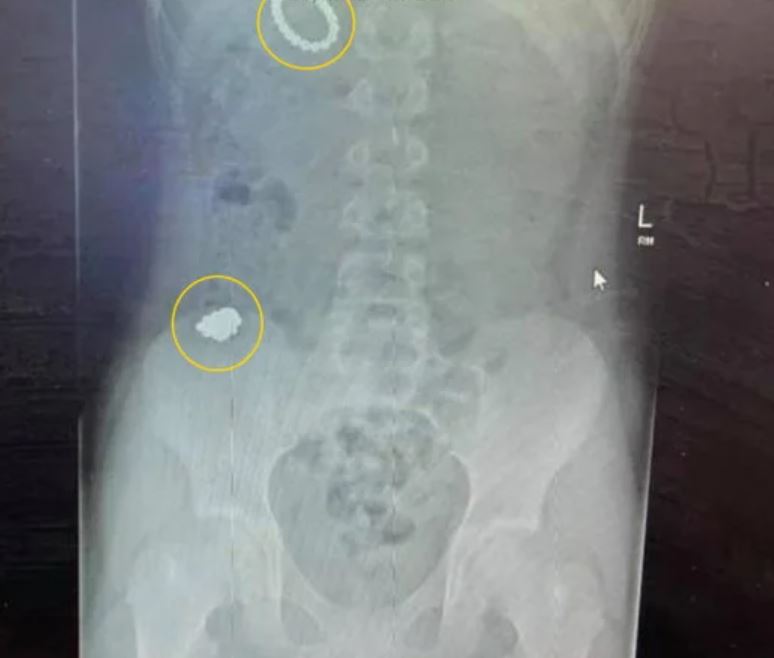 Boy, 12, undergoes six-hour surgery after swallowing 54 magnets to see if he'd become magnetic 3