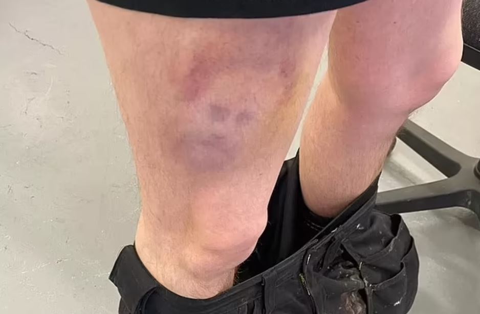 A footballer discovers a bruise on his leg, resembling Prince Harry's face. Image Credits: Jam Press