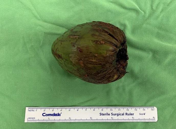 Doctor removed coconut from man's rectum 3
