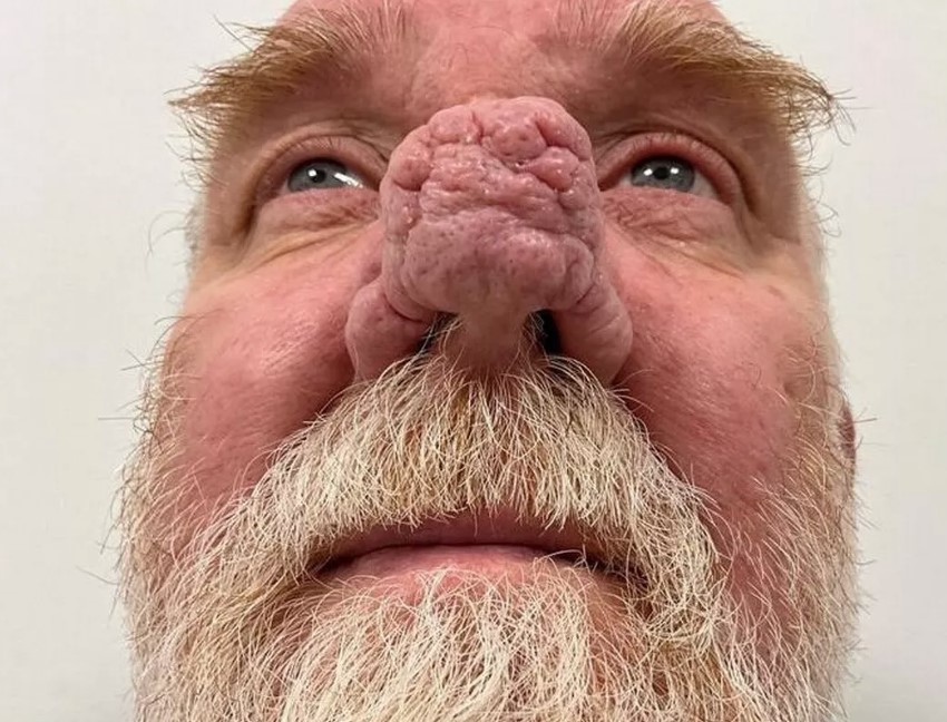 A man faced isolation due to an unusual nose growth. Image credit: Ever Clinic/SWNS