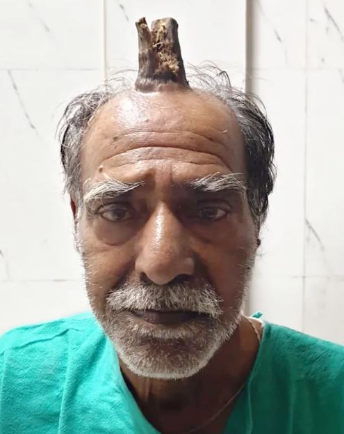 Dr. Vishal Gajbhiye performs surgery to remove the 'devil horn' growing on a man's head. mage Credits: Credit: SWNS:South West News Service