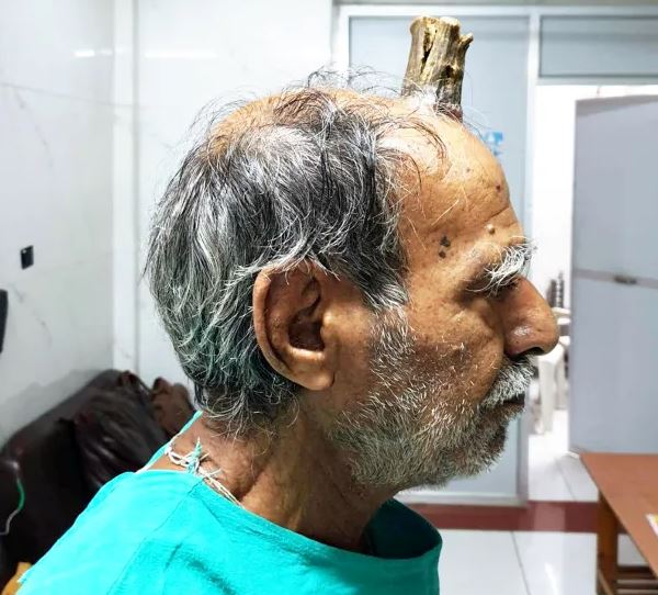 Man shocked by four-inch 'devil horn' growing on head. Image Credits: Credit: SWNS:South West News Service