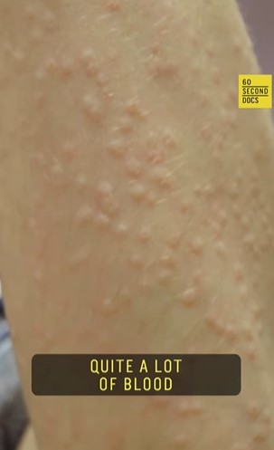 Man intentionally gets bitten by thousands of mosquitoe for scientific research 3