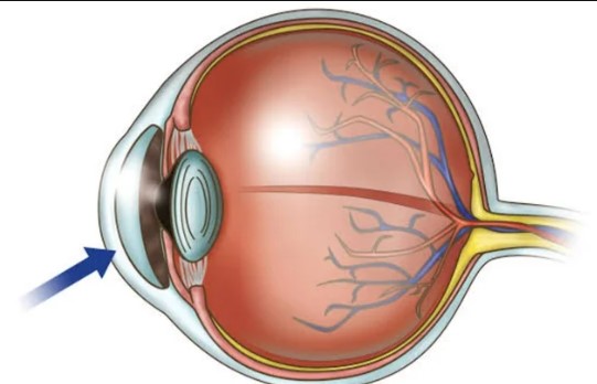 Astigmatism can be present from birth or develop due to factors like injuries or genetics. Image Credits: @r/interestingasf**k