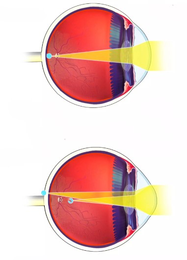 Diagnosis involves an eye exam to measure eye curvature and determine appropriate treatment. Image Credits: Getty