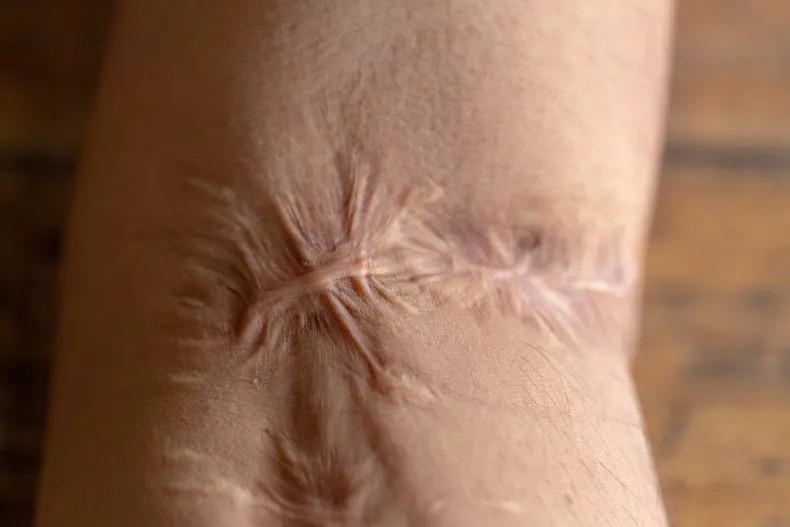 She accused the doctor of cutting too much skin that left her with large and painful scars